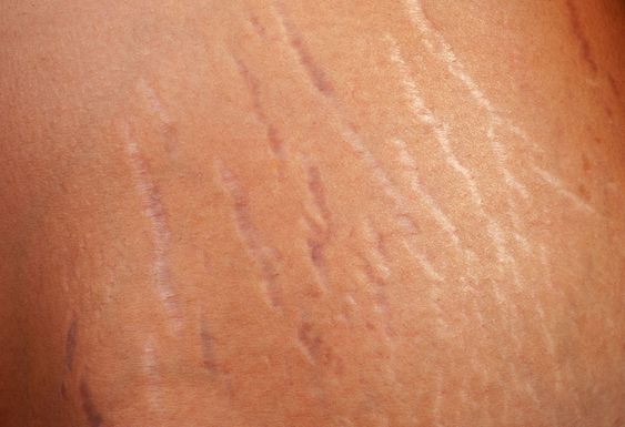 علت ایجاد ترک های پوستی